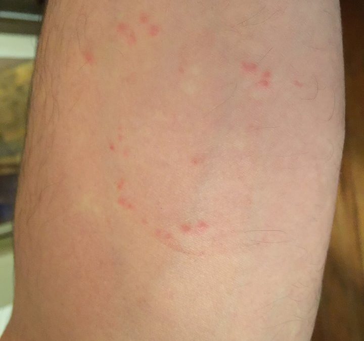 bed bug bites