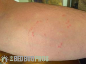 Bed Bug Bites | Picture of Bed Bug Bites | Pattern of Bed Bug Bites